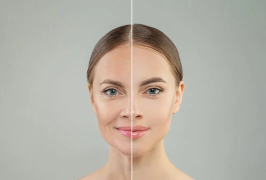 Deep plane facelift em Belém