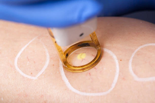 Laser para tratamento de melasma