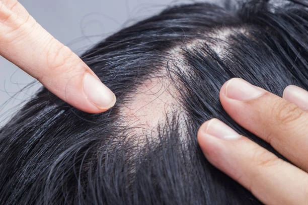 Tratamento capilar para queda de cabelo