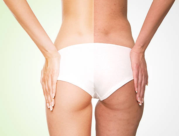 Tratamento para celulite no glúteo