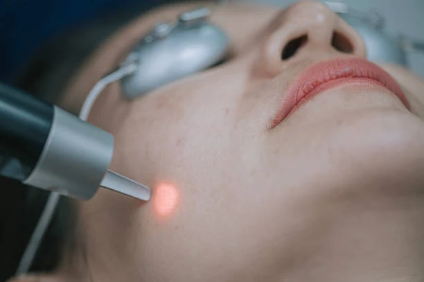 Tratamento a laser para melasma em Ananindeua