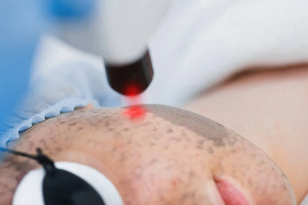 Tratamento a laser para melasma em Belém