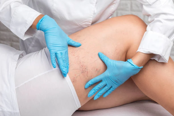 Tratamento a laser para vasinhos e varizes